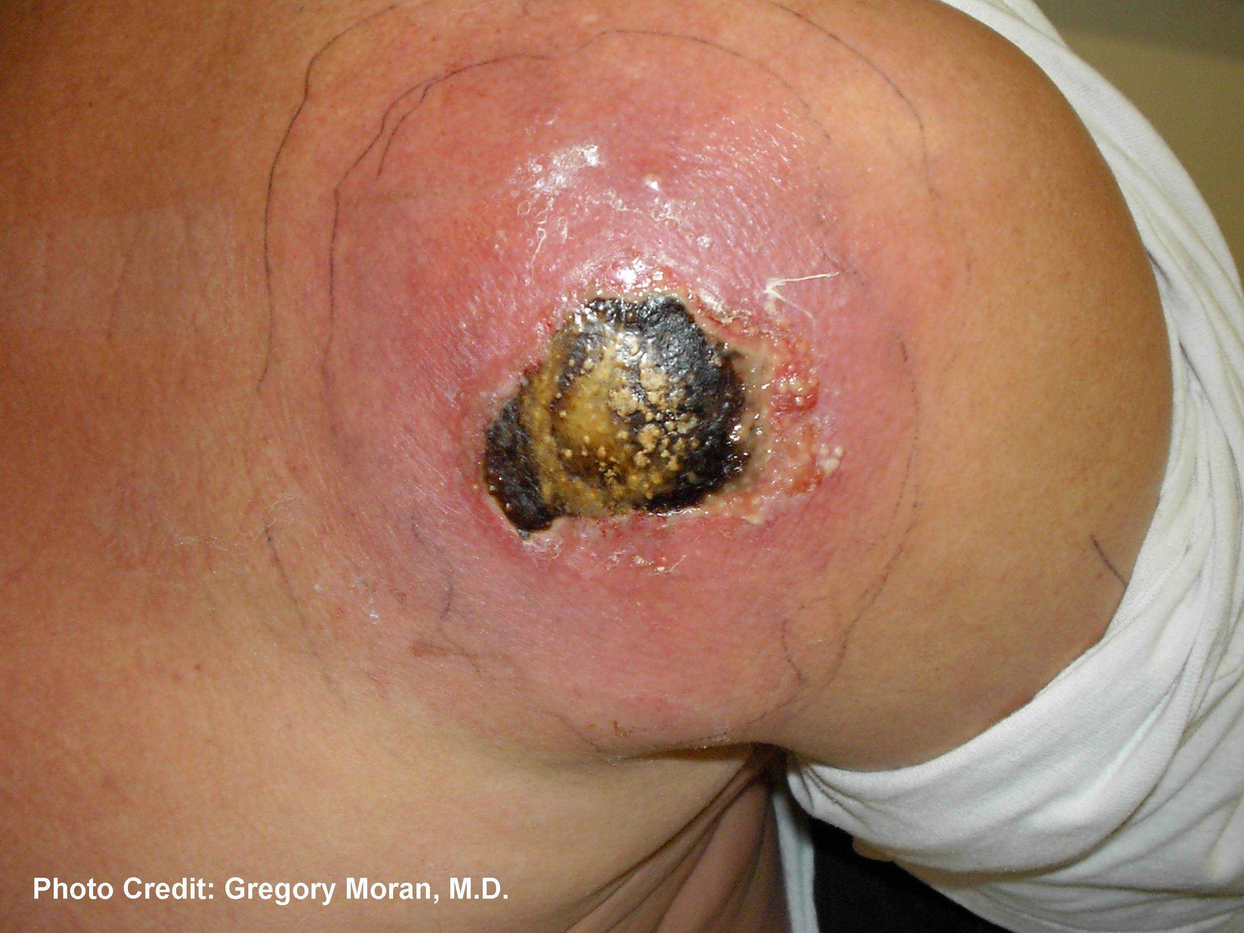 Cutaneous abscess caused by MRSA