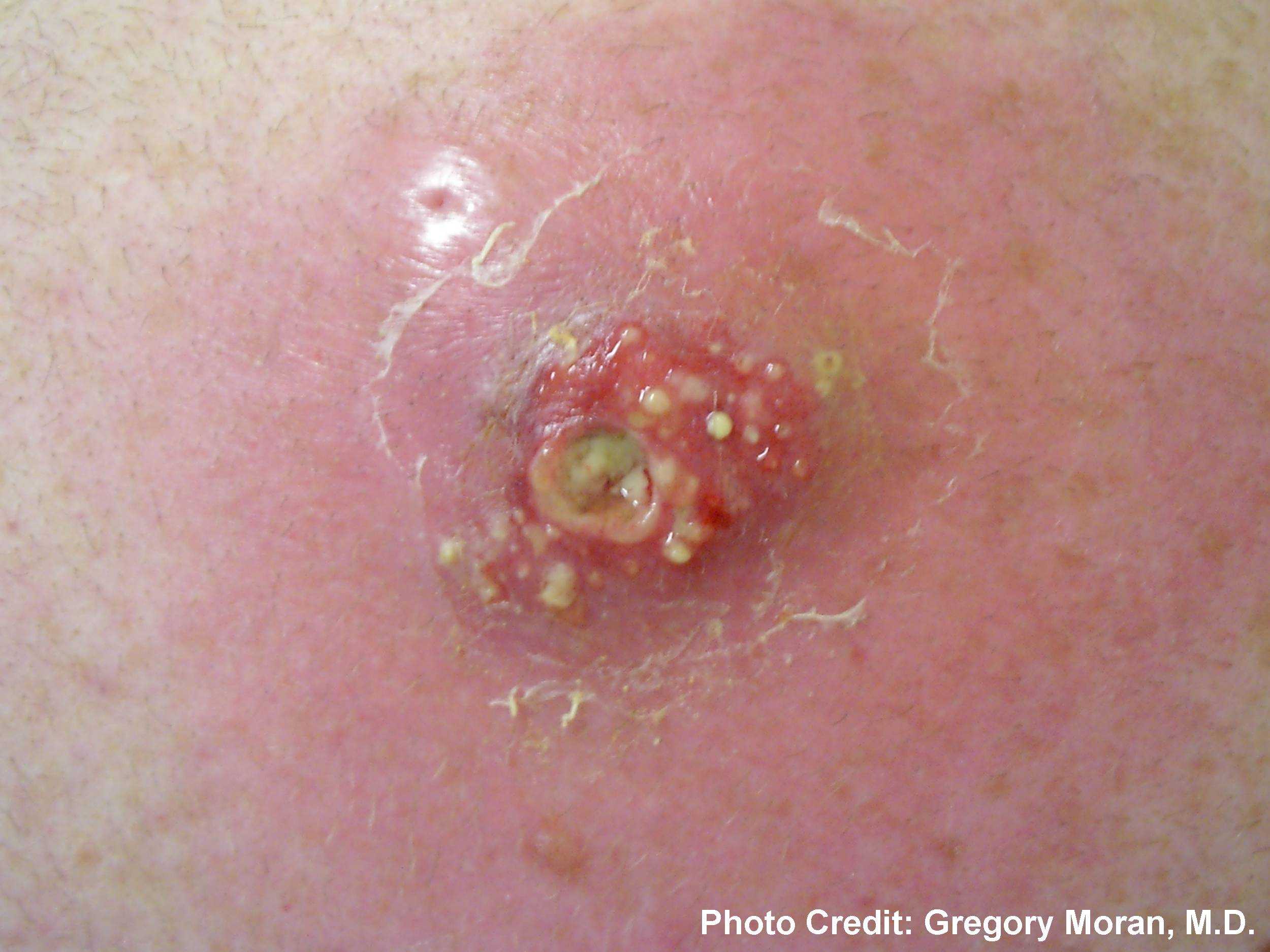 Cutaneous abscess caused by MRSA