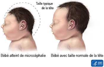 Bébé avec taille normale de la tête