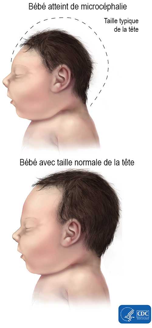 Bébé avec taille normale de la tête