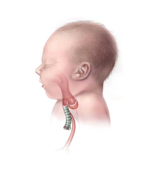 Esophageal Atresia Type C