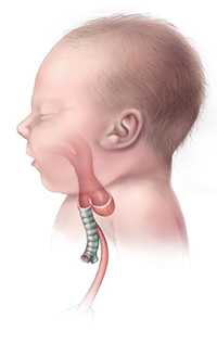 Esophageal Atresia Type C