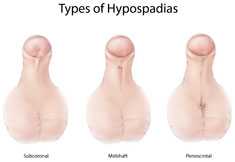 Picture of Types of Hypospadias