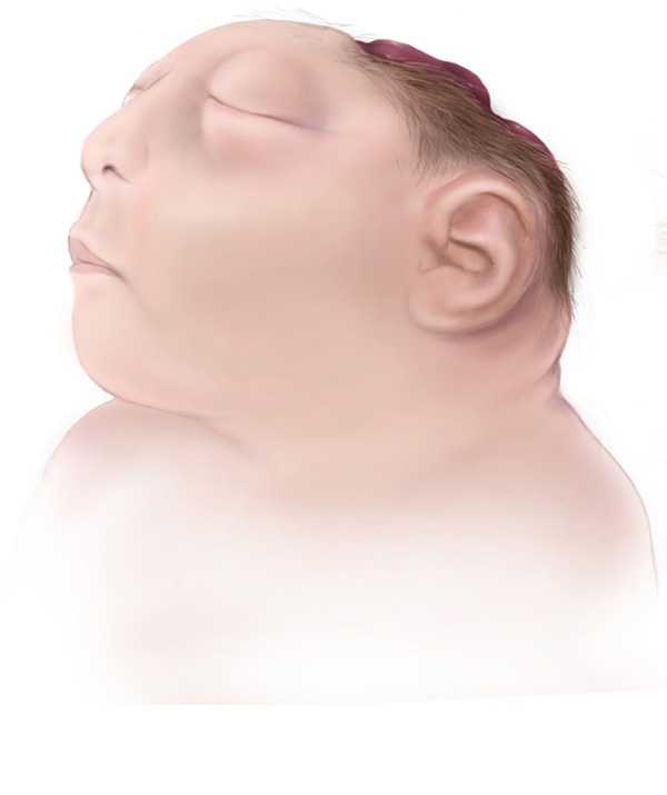 Anencephaly