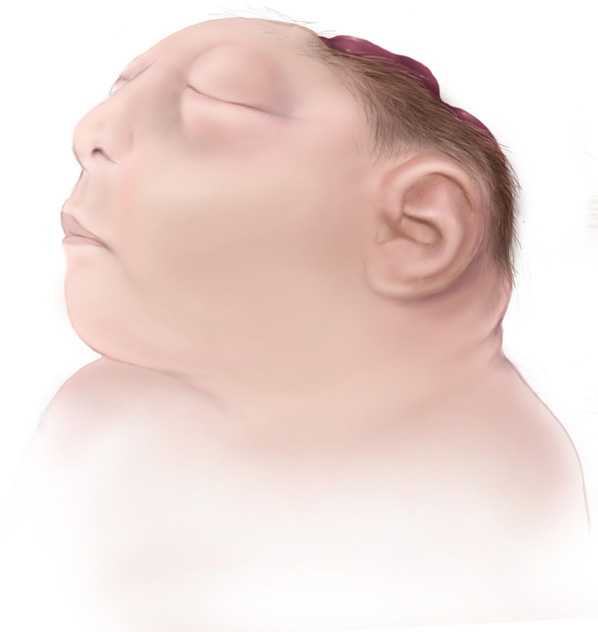 Anencephaly