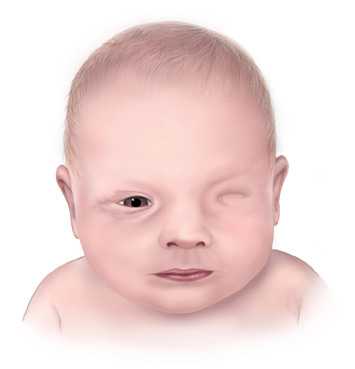 Image: Anophthalmia 