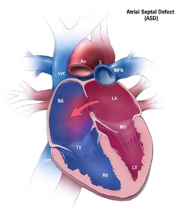 Atrial Septic Defect