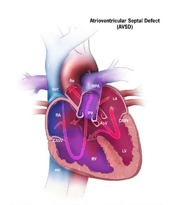 Atrioventricular Septal Defect