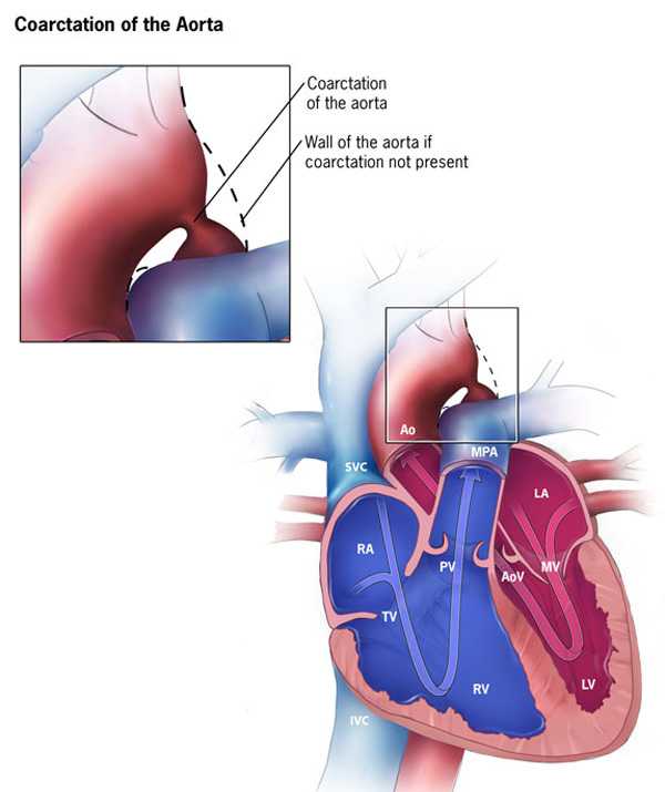 Coarctation of the Aorta