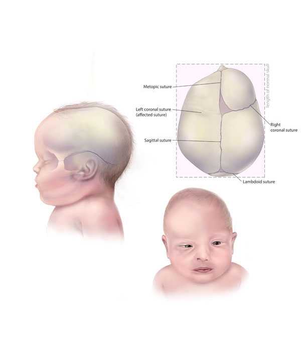 Coronal Craniosynostosis