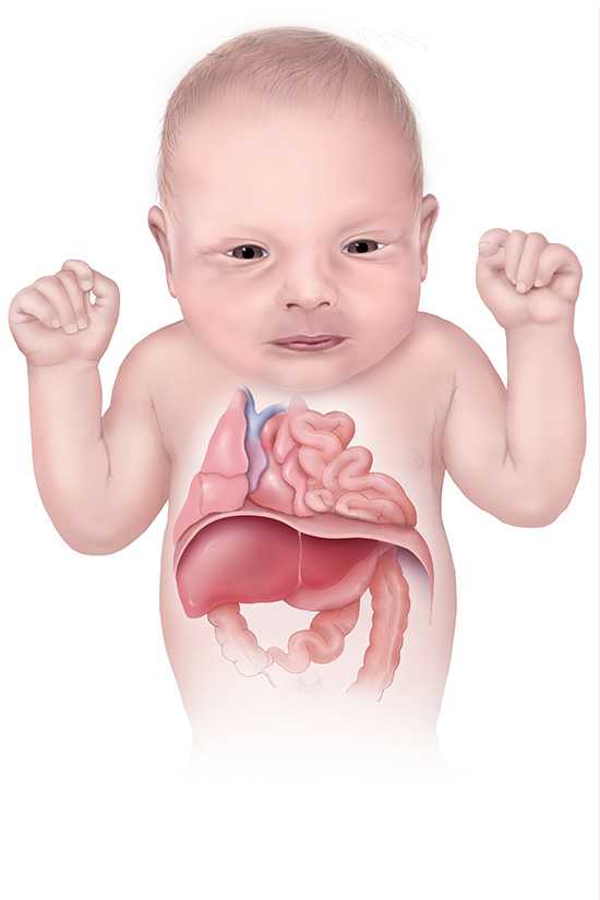 Diaphragmatic Hernia