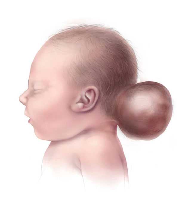 Encephalocele