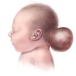 Picture of Encephalocele