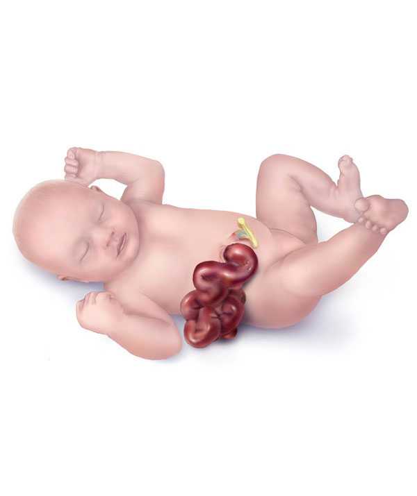 Gastroschisis