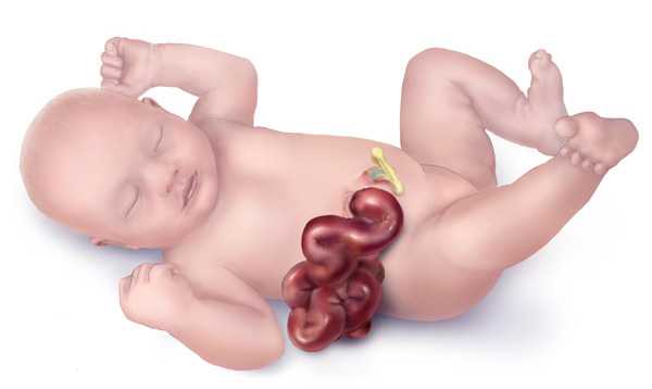 	Gastroschisis