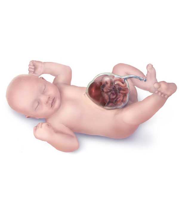 Omphalocele