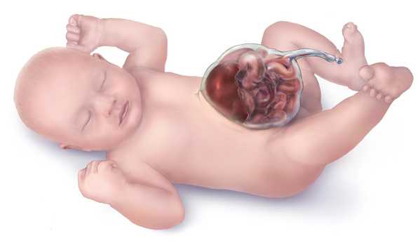 	Omphalocele