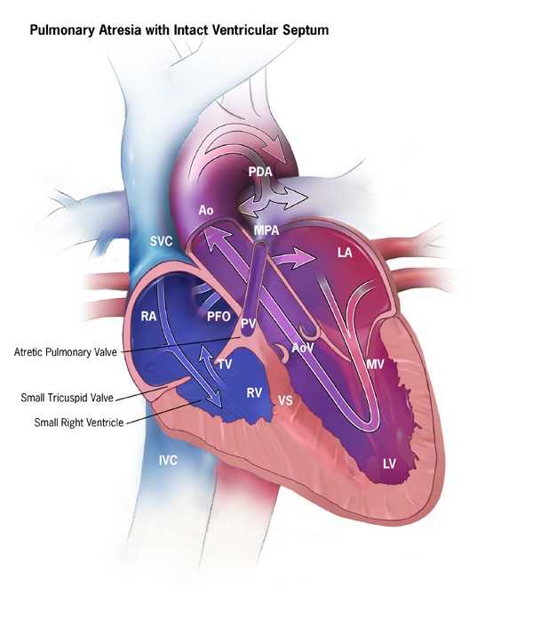 Pulmonary Atresia with Intact Ventricular Septum