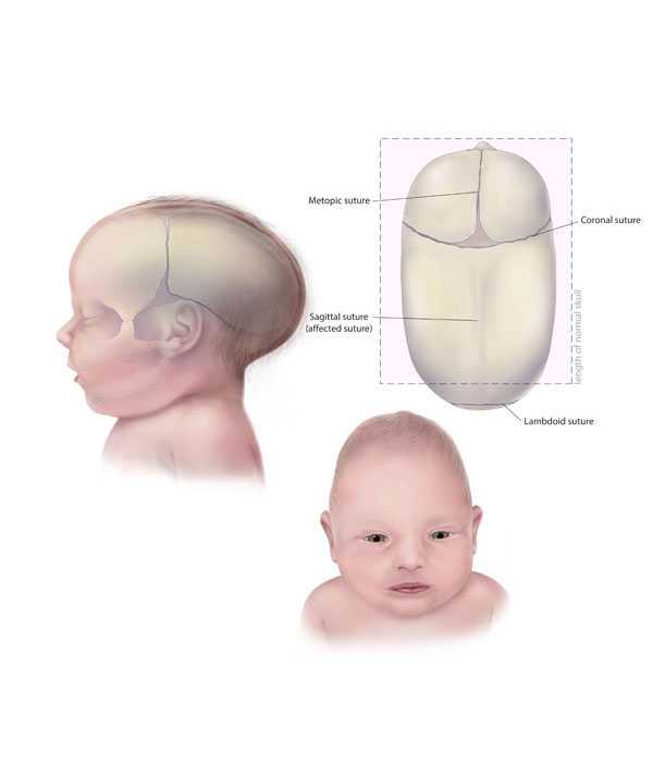 Sagittal Craniosynotosis