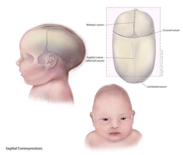 Sagittal Craniosynostosis