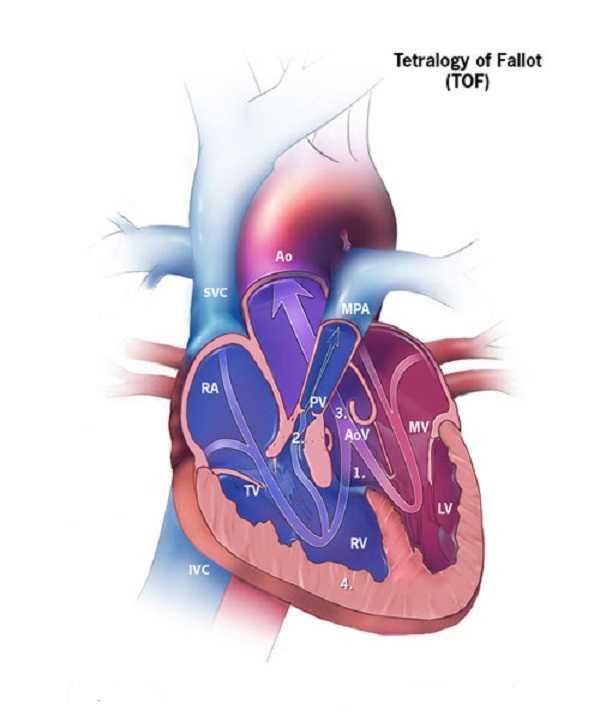 Tetralogy of Fallot