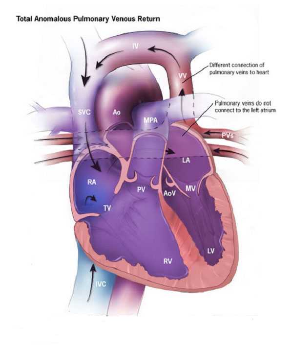 Total Anomalous Pulmonary Venous Return