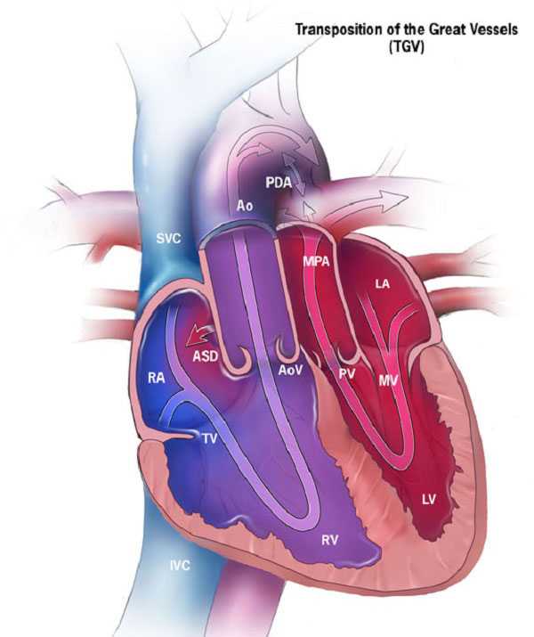 D-Transposition of the Great Arteries