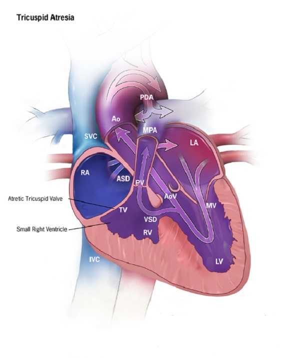 Tricuspid Atresia