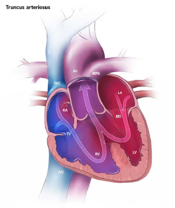 Truncus Arteriosus