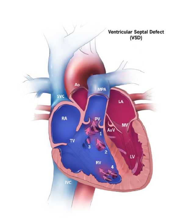 Ventricular Septal Defect