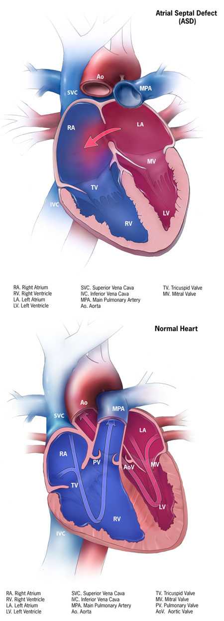 Atrial Septal Defect