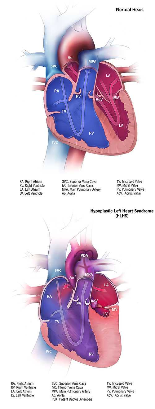 Hypoplastic Left Heart Syndrome