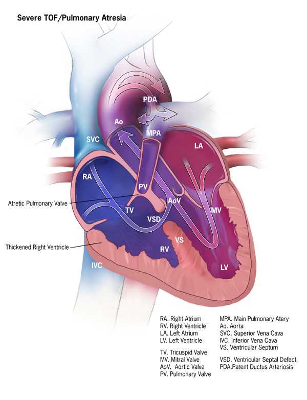 Hypoplastic Left Heart Syndrome