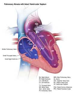 Pulmonary Atresia with Intact Ventricular Septum