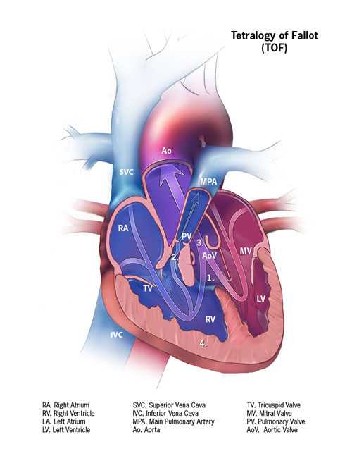 Truncus arteriosus