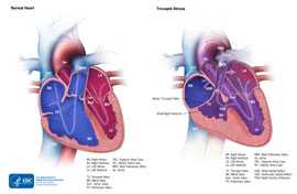 Tricuspid Atresia Comparison