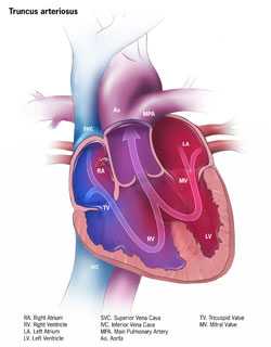 Truncus Arteriosus