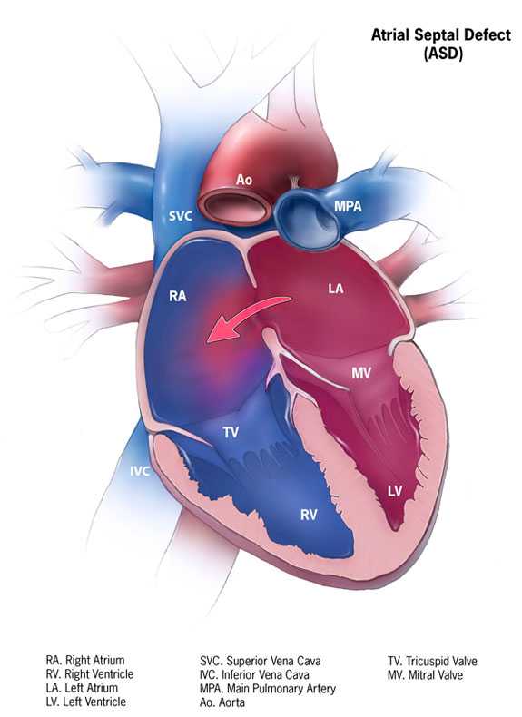 Atrial Septal Defect