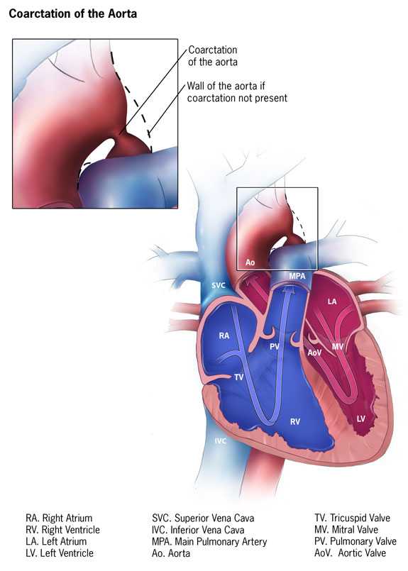 Hypoplastic Left Heart Syndrome