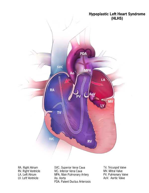 Hypoplastic Left Heart Syndrome