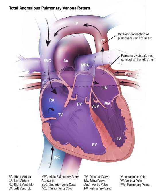 Truncus arteriosus