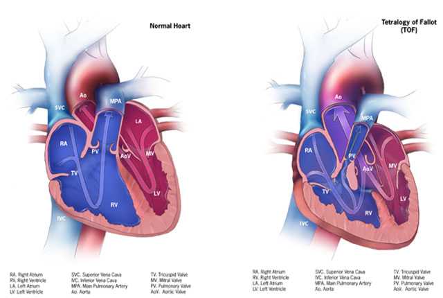 Truncus arteriosus