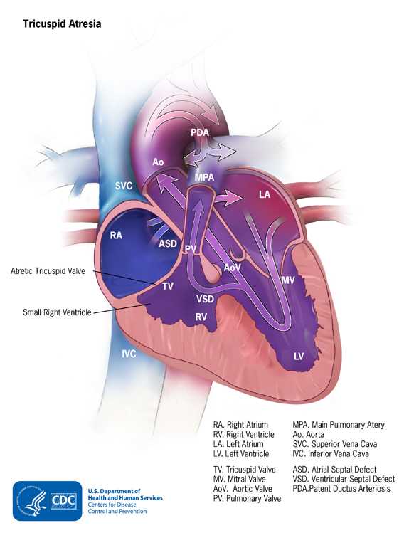 Tricuspid Atresia