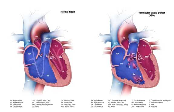 Ventricular Septal Defect (VSD)