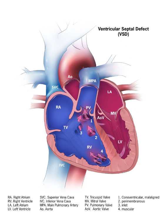 Ventricular Septal Defect