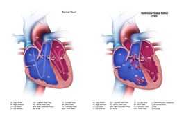 	Ventricular septal defect