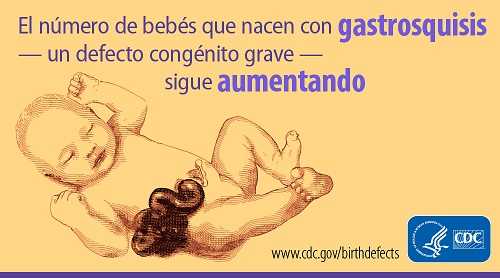 El número de bebés que nacen con gastrosquisis - un defecto congénito grave - sigue aumentando