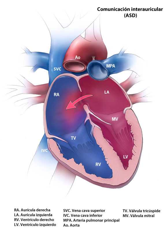 	Atrial Septal Defect