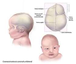 	Craneosinostosis coronal unilateral