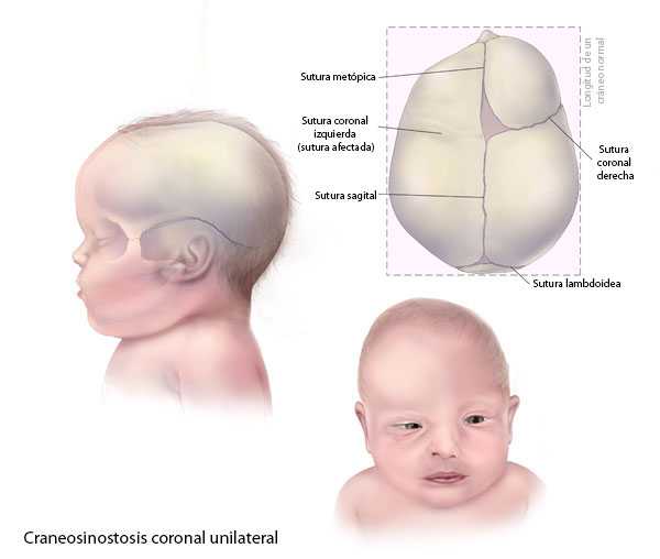 	Craneosinostosis coronal unilateral